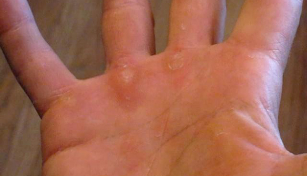 tennis-callus-hands